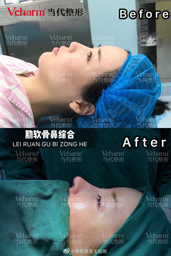 重庆张国强和王旭明哪个隆鼻好 王旭明张国强案例对比预约 整容资讯网