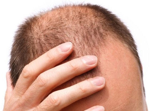 UBAT LEBATKAN RAMBUT,ELAK RAMBUT JADI BOTAK DI USIA MUDA 