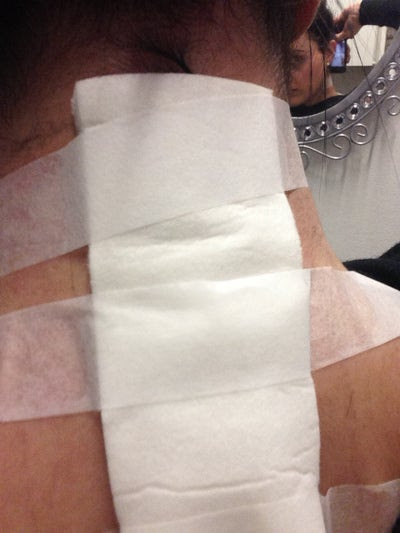 Aftercare Tattoo Removal with Q Switch? (photo) Doctor Answers, Tips