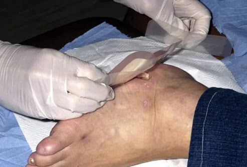 People with diabetes often experience nerve damage that can make it more difficult to feel their feet.  