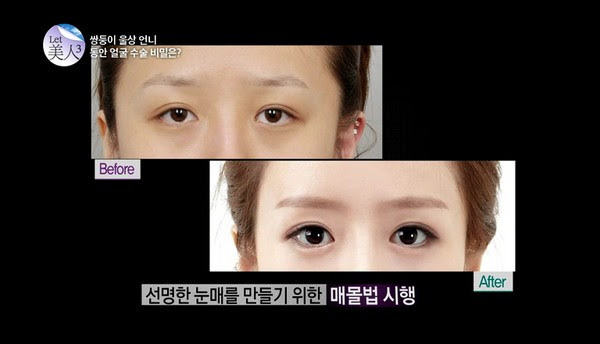 twin sister before after surgery 05 asiantown.net