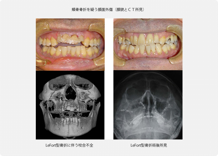 顔面骨骨折 診療のご案内 琉球大学病院 形成外科