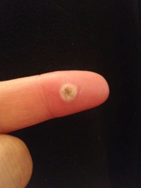 The main symptom of a wart is a fleshy growth. Photos of Warts on Hands and Fingers ~ How To Remove Moles