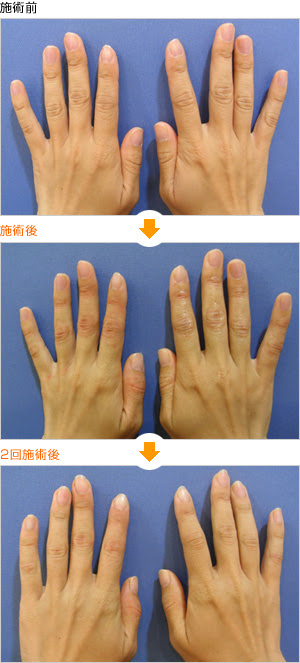 手背 指の悩み 名古屋タワーサイドクリニック