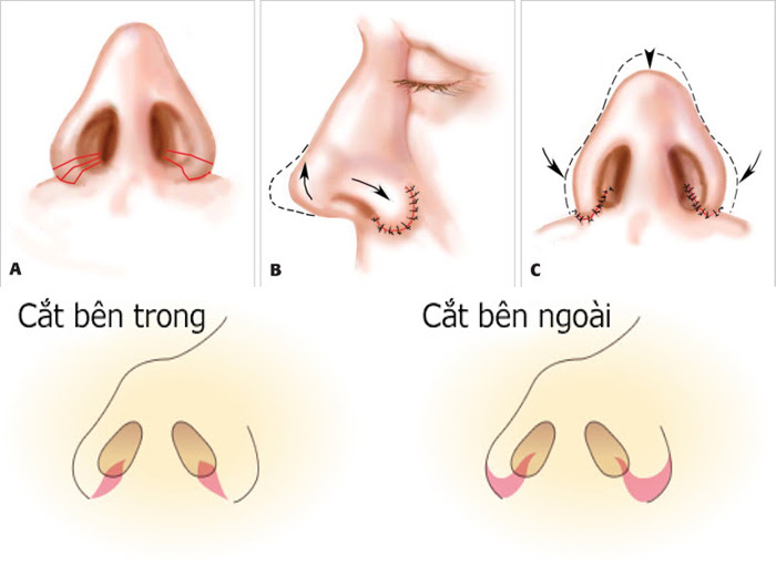 phau-thuat-cat-canh-mui