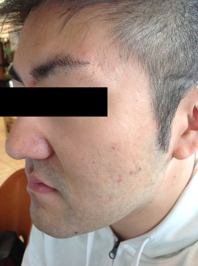 貨幣状湿疹の体験談 新潟県 29歳 男性 写真あり 春日部第一薬局 埼玉県春日部市