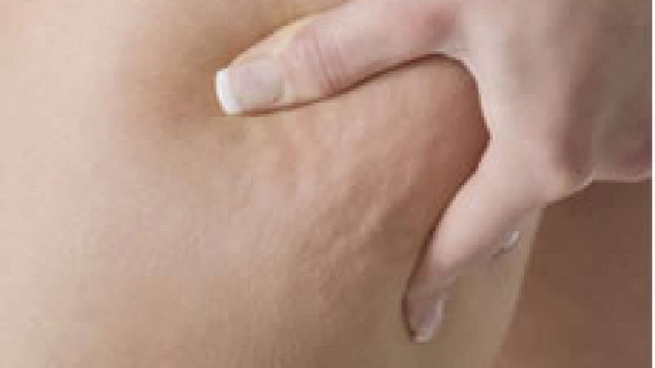 cellulite o ritenzione idrica