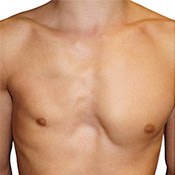 Poland Syndrome Terminology Anatomikmodeling