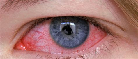 aid treatment  conjunctivitis pink eye