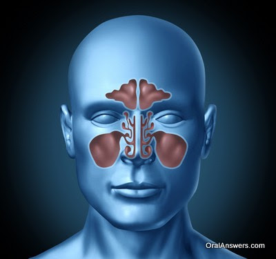 Sinusitis and Tooth Pain