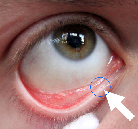 Gerstenkorn Hordeolum Am Auge Ursache Behandlung