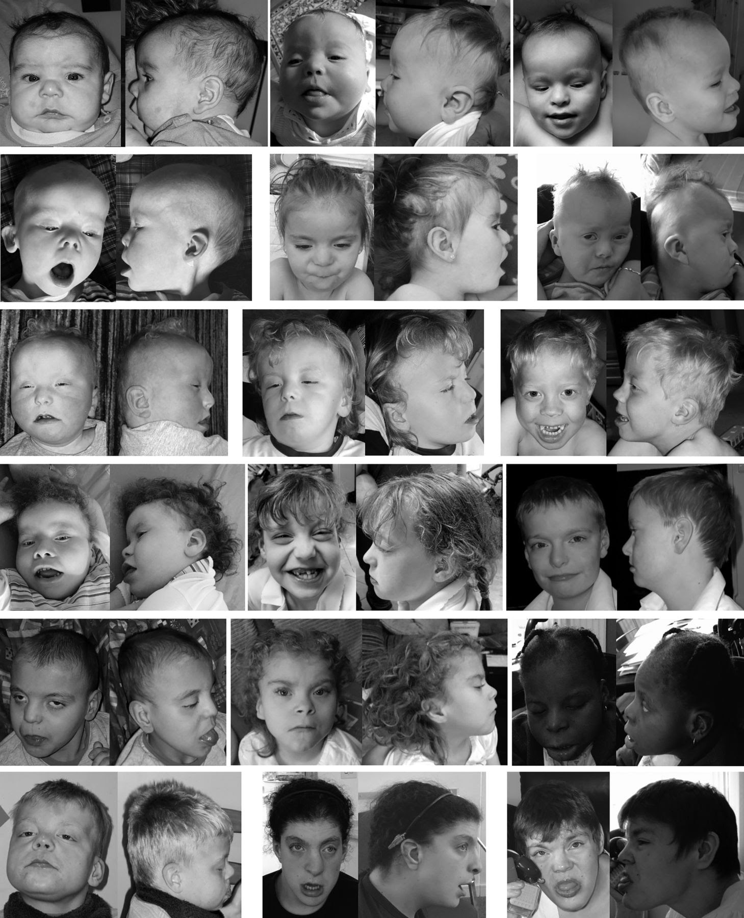 Pallister-Killian syndrome: a study of 22 British patients ...
