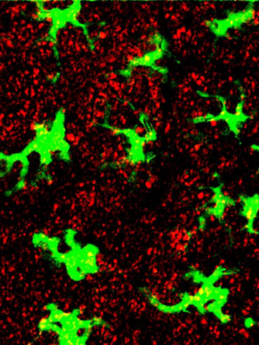 Immune cells, tagged with green fluorescent protein, are surrounded by nanoparticles (red), after the nanoparticles are injected into the skin of a mouse
