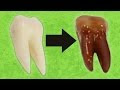 What Happens When You Put Teeth In Soda?