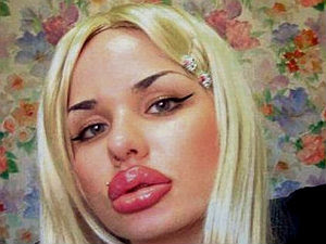 russia-woman-with-world-biggest-lips