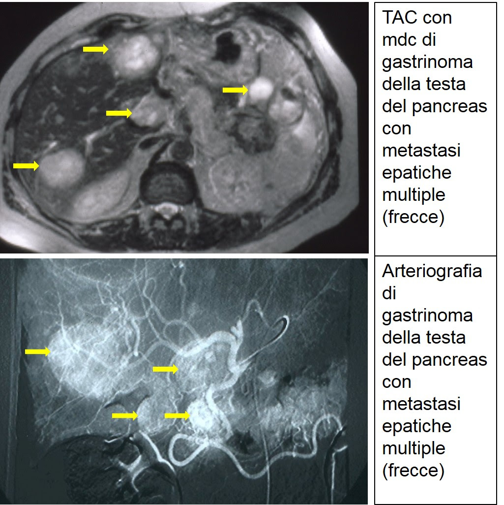 I Tumori Endocrini Del Pancreas Wirsung
