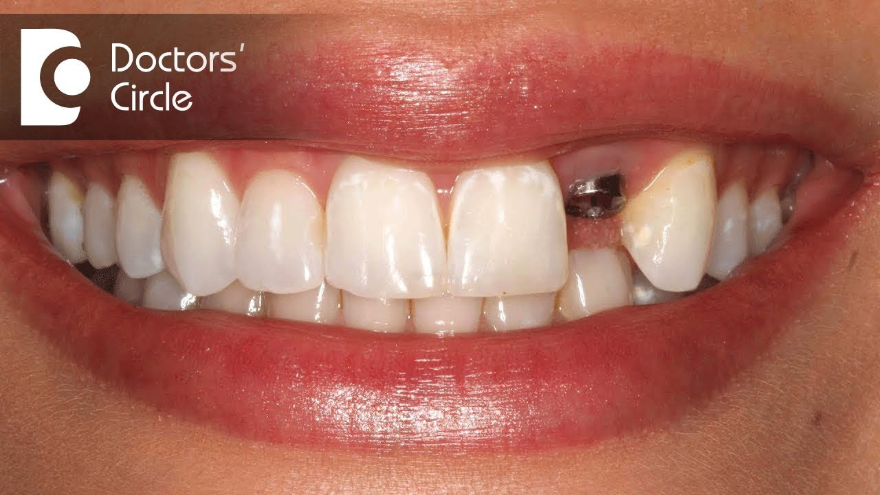 New teeth now implants cost