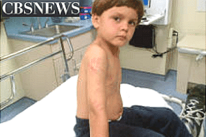 O garoto Joey Welch mostra os ferimentos causados pelo jacaré no braço, no ombro e no peito