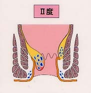 痔核 いぼ痔の治療 日帰り手術 注射治療 痔核根治手術 Of 福岡の大腸 肛門科専門医による痔 肛門科 大腸内視鏡 大腸カメラ のサイト 大腸肛門武者修行