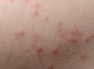 Bed bug bite pictures