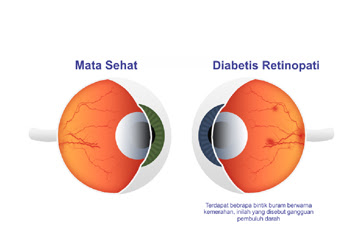 Retinopatiadalah Tanda Penyebab Gejala Cara