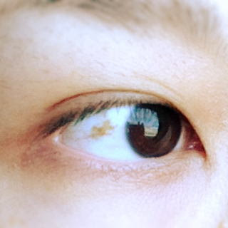 横浜相鉄ビル眼科医院 白目のしみ しろめのしみ 結膜の母斑 けつまくのぼはん 結膜腫瘍 けつまくしゅよう の手術 レーザー治療