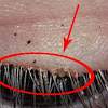 Eyelash Lice Pictures : Insects living In The woman's Eyelashes - The Horrifying - Eyelash lice aren’t the same as head lice, and actually stem from pubic lice.
