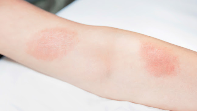 Treat Poison Ivy Rashes At Home With These Surprising Hacks