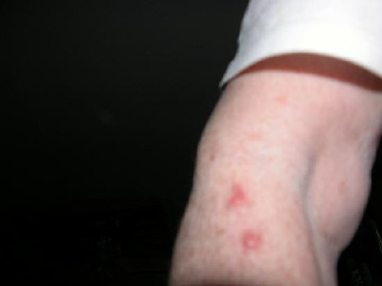 Related Pictures infected bed bug bites imgur