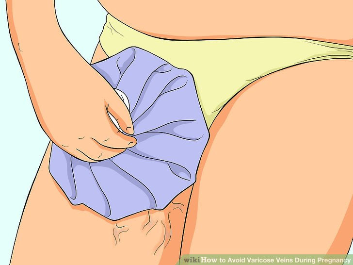 Avoid Varicose Veins During Pregnancy Step 8 Version 2.jpg