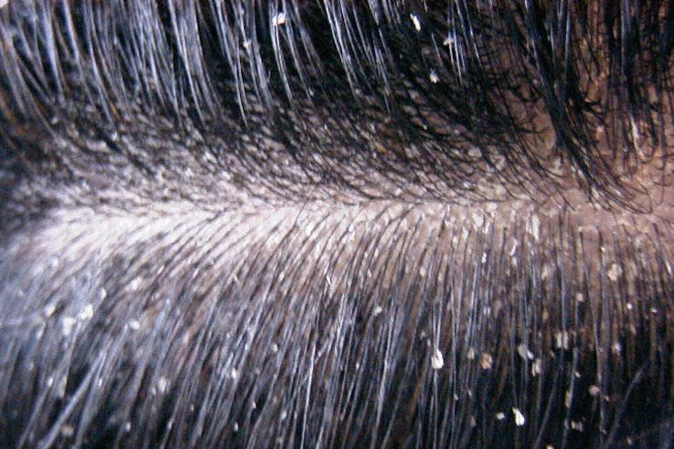 How To Get Rid Of Dry Scalp