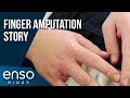 Wedding Ring Degloving Injury