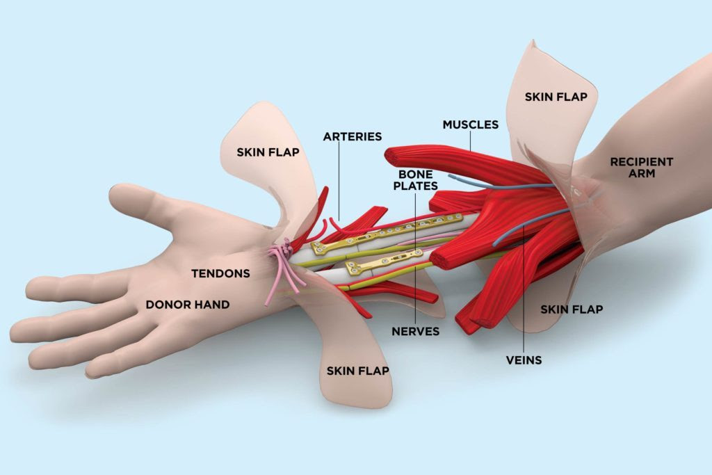 october-2017-03-FEA-Hand-Transplant
