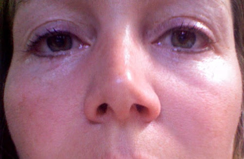 Karine is healing fast from her upper and lower eyeliner tattooing procedure 