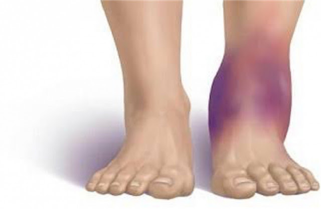 足関節捻挫 船橋の整体 もみの木鍼灸接骨院