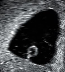 sac test but yolk positive pregnancy no for patients: The Miscarriage IVF Specialist's IVF Blog sac test but yolk positive pregnancy no for patients: The Miscarriage IVF Specialist's IVF Blog