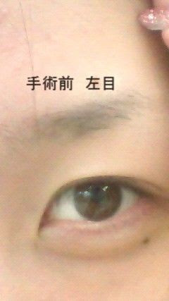埋没整形してきました 整形ブログ