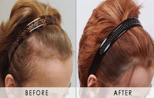 Hair Transplant Before and After
