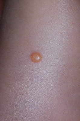 皮膚病 皮膚の病気 ３ 稲葉クリニック 杉並区皮膚科
