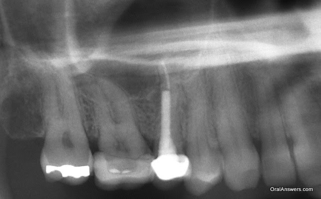 Sinus Infection Caused by a Tooth Abscess