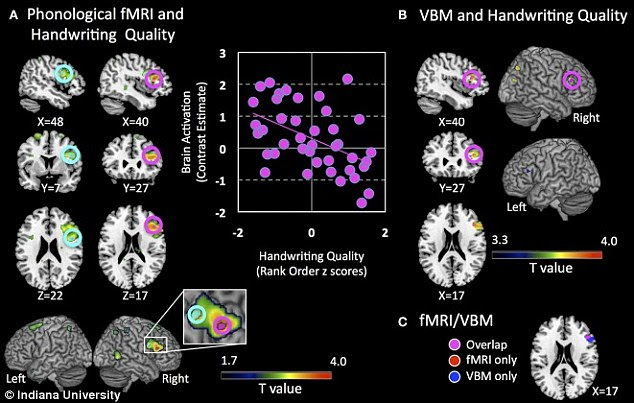 In a recent study from Indiana University, researchers conducted brain scans (pictured) on 5-year-olds before and after receiving different letter-learning tasks. In children who practiced writing letters by hand, the neural activity was more enhanced and 'adult-like' than in those who had simply looked at letters