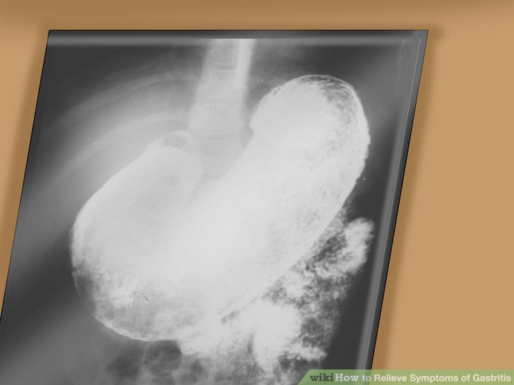 Relieve Symptoms of Gastritis Step 4 Version 2.jpg