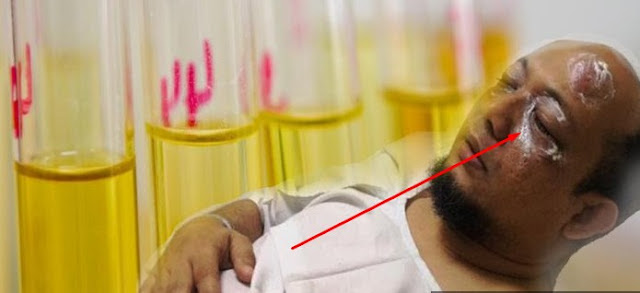 Wajib Tahu! Pertolongan Pertama Saat Kena Cairan Kimia, dari Lepas Pakaian hingga Basuh Tubuh dengan Air Soda http://ift.tt/20kt43r - Berita Terbaru Terkini Hari Ini - Penyidik senior Komisi Pemberantasan Korupsi (KPK), Novel Baswedan, mendapat siraman air keras dari oknum tak dikenal Selasa (11/4/2017) pagi saat pulang dari salat subuh berjamaah di masjid dekat rumah. Karena kejadian ini, beberapa bagian tubuh Novel mengalami luka bakar.