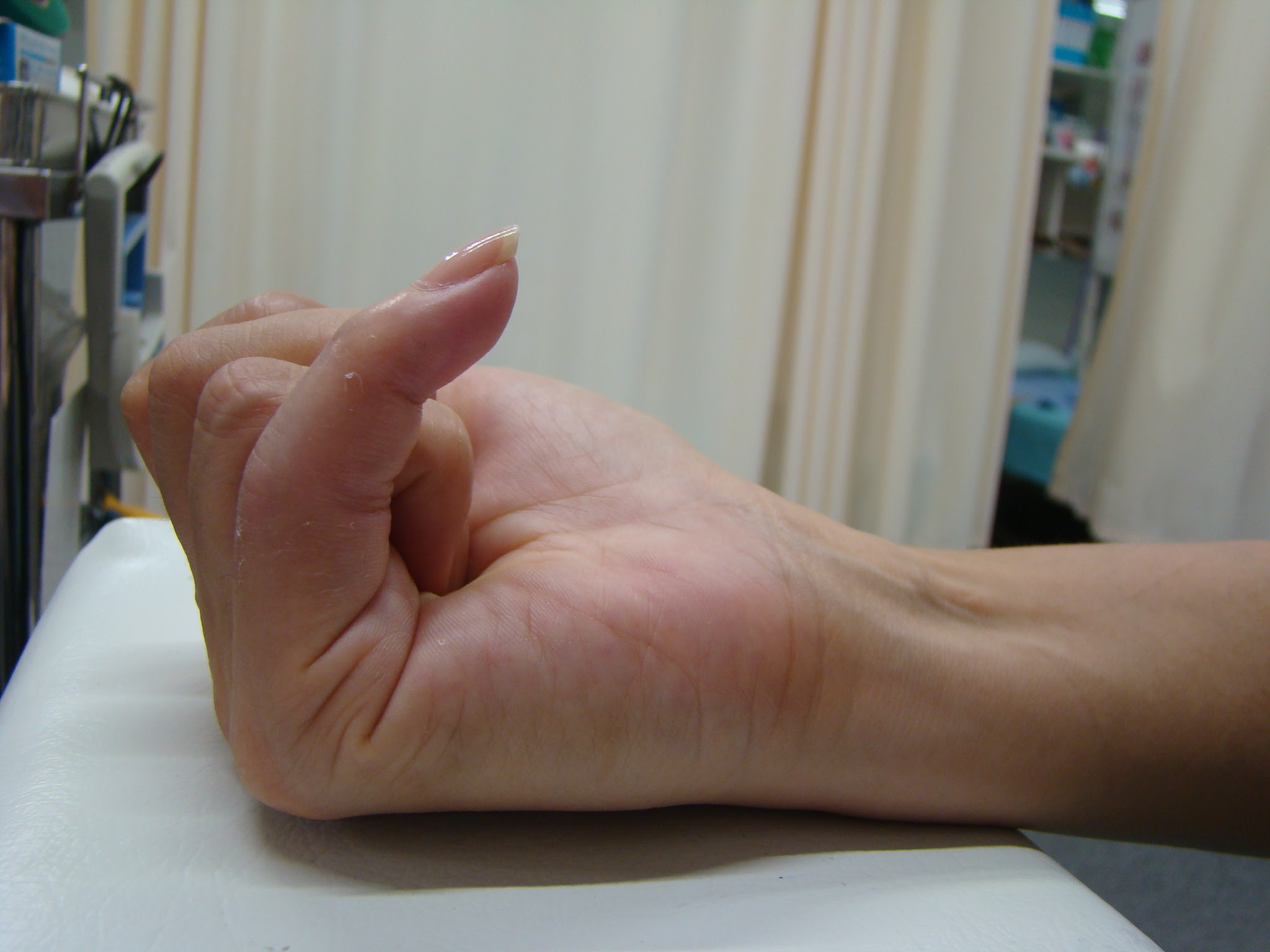 骨折 スタッフブログ 鎌倉市のスポーツ外傷 怪我治療なら大船接骨院