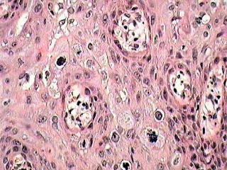 皮膚の悪性腫瘍 皮膚がん 品川区 あおよこ皮膚科クリニック