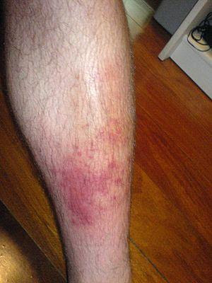Localized cellulitis