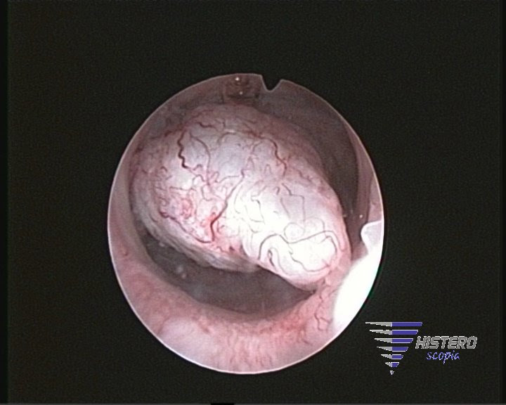 polipo endometrial