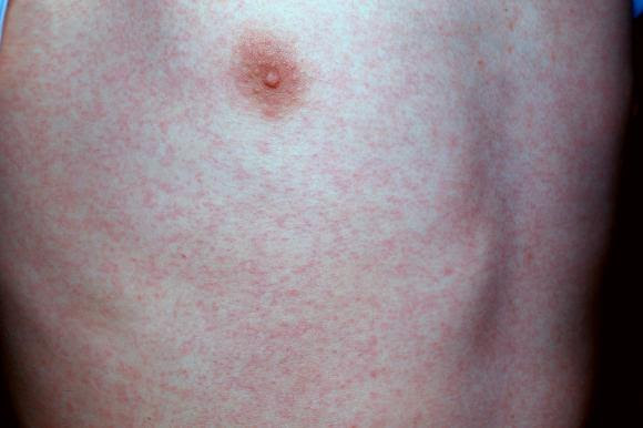 Medizin: Die häufigsten Kinderkrankheiten - Bilder & Fotos ...