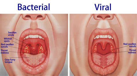 tonsillitis  symptoms treatment home remedies