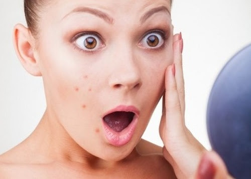Thay đổi hormone là nguyên nhân gây ra mụn ở tuổi dậy thì.